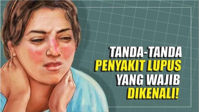 Fakta Penyakit Lupus