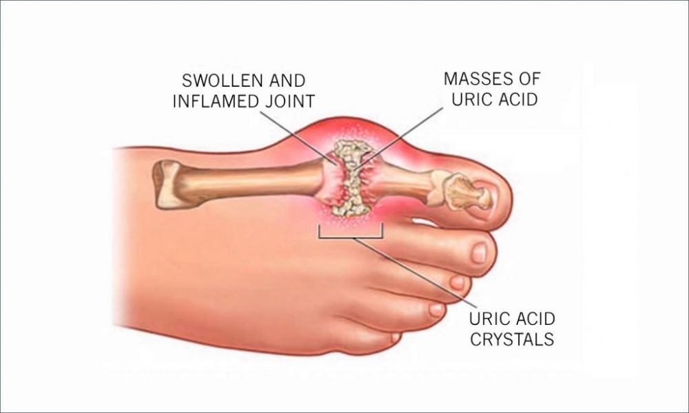 Waspadai 6 Jenis Artritis atau Radang Sendi yang Bisa Kamu Alami